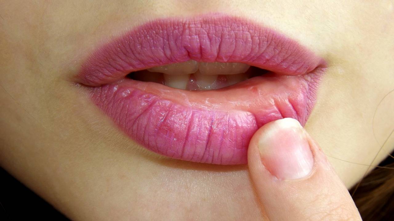 Как лечить заеды в уголках рта