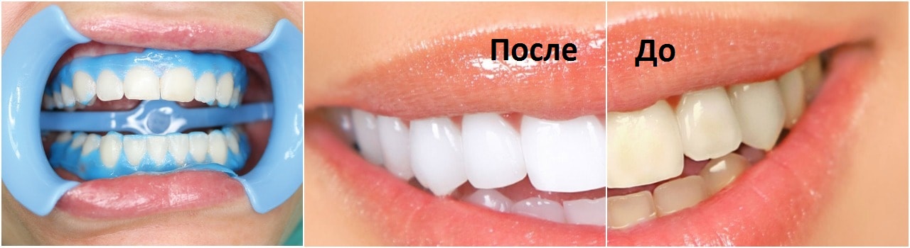 Химический метод отбеливания зубов