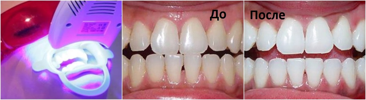 Лазерное отбеливание зубов фото до и после